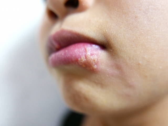 口内から全身へ：カンジダ感染の多様な症状と対処法