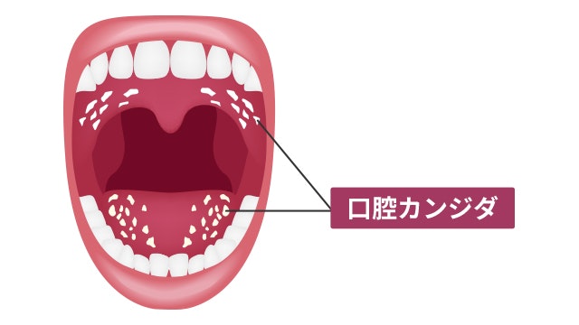 口の中に白い膜？口腔カンジダ症とは